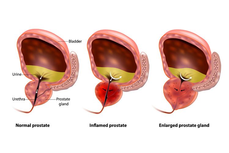 Diagram of healthy prostate vs. prostate affected by various conditions